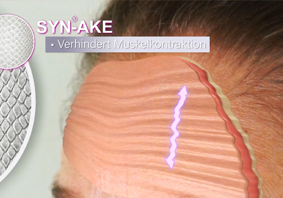 skineance-muskelkontraktion skineance-muskelkontraktion